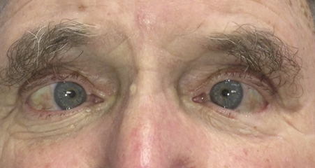 Common eye conditions in adults - 1